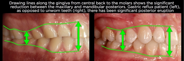 Managing Over-Eruption Following Tooth Wear Frank Spear Managing Over eruption Following Tooth Wear Figure 12
