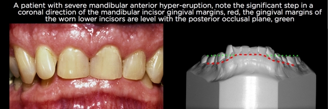 Managing Over-Eruption Following Tooth Wear Frank Spear Managing Over eruption Following Tooth Wear Figure 13