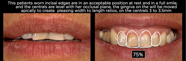 Managing Over-Eruption Following Tooth Wear Frank Spear Managing Over eruption Following Tooth Wear Figure 14