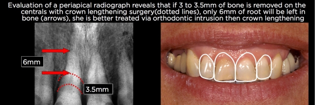 Managing Over-Eruption Following Tooth Wear Frank Spear Managing Over eruption Following Tooth Wear Figure 15