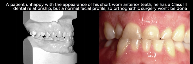 Managing Over-Eruption Following Tooth Wear Frank Spear Managing Over eruption Following Tooth Wear Figure 16