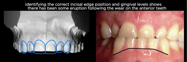Managing Over-Eruption Following Tooth Wear Frank Spear Managing Over eruption Following Tooth Wear Figure 17