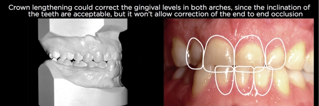 Managing Over-Eruption Following Tooth Wear Frank Spear Managing Over eruption Following Tooth Wear Figure 18