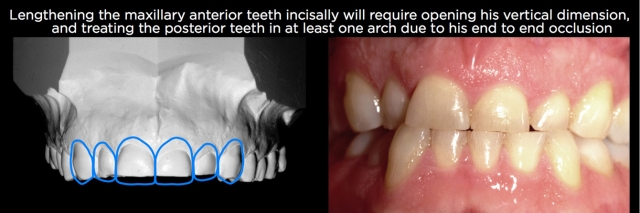 Managing Over-Eruption Following Tooth Wear Frank Spear Managing Over eruption Following Tooth Wear Figure 19