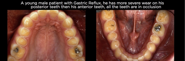 Managing Over-Eruption Following Tooth Wear Frank Spear Managing Over eruption Following Tooth Wear Figure 2