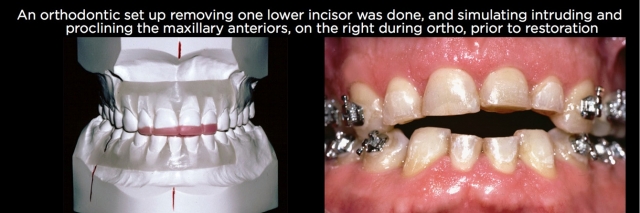 Managing Over-Eruption Following Tooth Wear Frank Spear Managing Over eruption Following Tooth Wear Figure 20