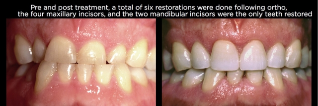 Managing Over-Eruption Following Tooth Wear Frank Spear Managing Over eruption Following Tooth Wear Figure 21