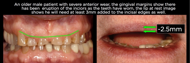 Managing Over-Eruption Following Tooth Wear Frank Spear Managing Over eruption Following Tooth Wear Figure 22