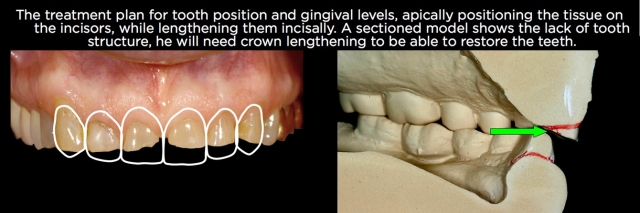 Managing Over-Eruption Following Tooth Wear Frank Spear Managing Over eruption Following Tooth Wear Figure 23