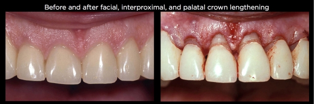 Managing Over-Eruption Following Tooth Wear Frank Spear Managing Over eruption Following Tooth Wear Figure 24