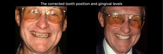 Managing Over-Eruption Following Tooth Wear Frank Spear Managing Over eruption Following Tooth Wear Figure 25