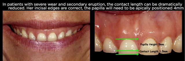 Managing Over-Eruption Following Tooth Wear Frank Spear Managing Over eruption Following Tooth Wear Figure 26