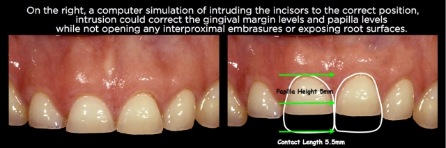 Managing Over-Eruption Following Tooth Wear Frank Spear Managing Over eruption Following Tooth Wear Figure 27