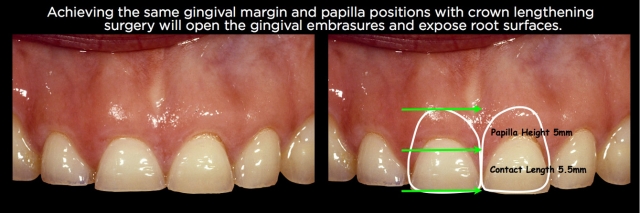 Managing Over-Eruption Following Tooth Wear Frank Spear Managing Over eruption Following Tooth Wear Figure 28