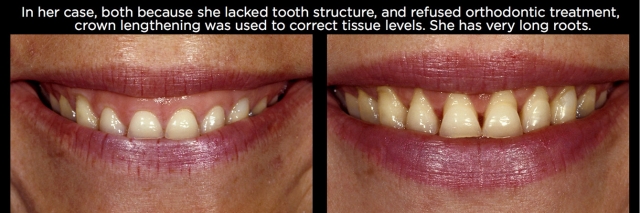Managing Over-Eruption Following Tooth Wear Frank Spear Managing Over eruption Following Tooth Wear Figure 29