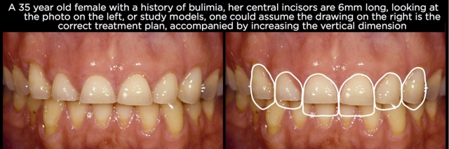Managing Over-Eruption Following Tooth Wear Frank Spear Managing Over eruption Following Tooth Wear Figure 3