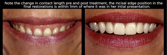 Managing Over-Eruption Following Tooth Wear Frank Spear Managing Over eruption Following Tooth Wear Figure 30