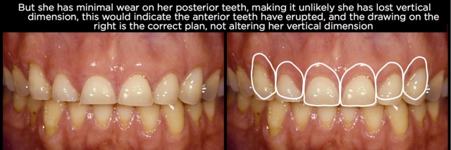 Managing Over-Eruption Following Tooth Wear Frank Spear Managing Over eruption Following Tooth Wear Figure 4