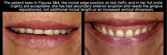 Managing Over-Eruption Following Tooth Wear Frank Spear Managing Over eruption Following Tooth Wear Figure 5