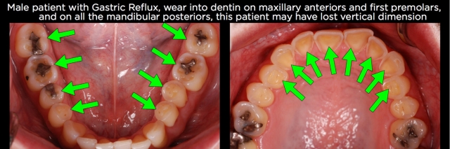 Managing Over-Eruption Following Tooth Wear Frank Spear Managing Over eruption Following Tooth Wear Figure 6