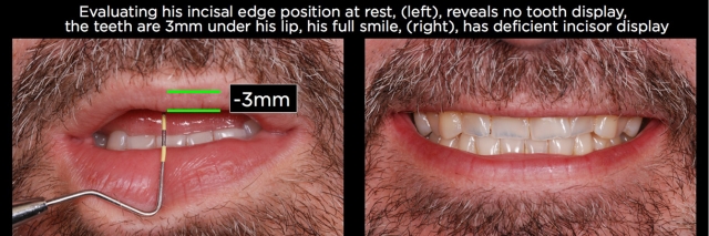 Managing Over-Eruption Following Tooth Wear Frank Spear Managing Over eruption Following Tooth Wear Figure 7