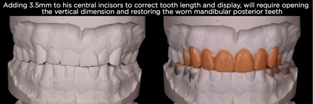 Managing Over-Eruption Following Tooth Wear Frank Spear Managing Over eruption Following Tooth Wear Figure 8