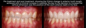 Over Eruption Managing Over-Eruption Following Tooth Wear - Spear Education