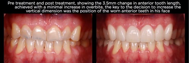 Managing Over-Eruption Following Tooth Wear Frank Spear Managing Over eruption Following Tooth Wear Figure 9