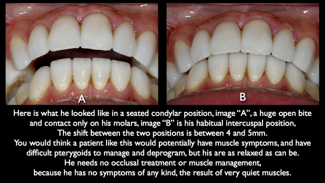 Frank Spear Muscle Deprogramming Figure 2