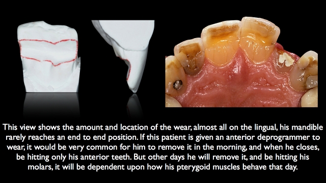 Frank Spear Muscle Deprogramming Figure 4