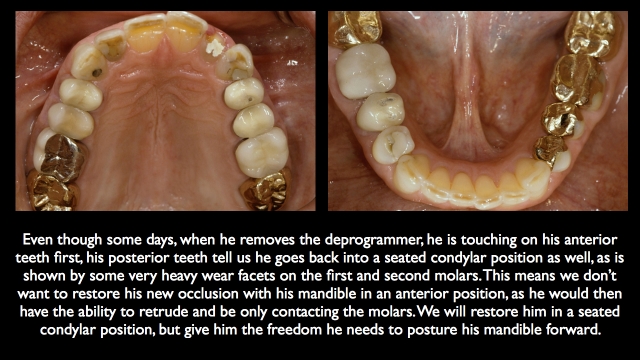 Frank Spear Muscle Deprogramming Figure 5