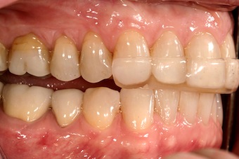 Occlusal Appliances: The Options Frank Spear Occlusal Appliances Featured Image