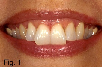 Positioning Maxillary Central Incisal Edges: Phonetics Frank Spear Positioning Maxillary Central Incisal Edges Figure 1