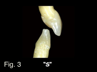 Positioning Maxillary Central Incisal Edges: Phonetics Frank Spear Positioning Maxillary Central Incisal Edges Figure 3 1