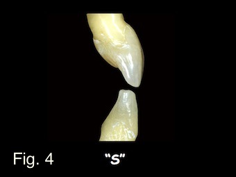 Positioning Maxillary Central Incisal Edges: Phonetics Frank Spear Positioning Maxillary Central Incisal Edges Figure 4