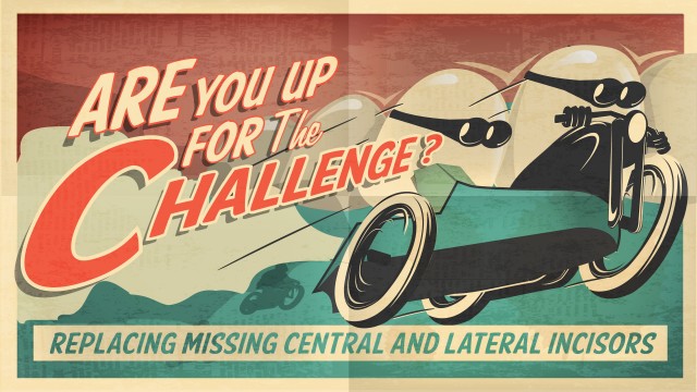 The Challenge of Replacing Missing Central and Lateral Incisors Frank Spear The Challenge of Replacing Missing Central and Lateral Incisors Featured Image