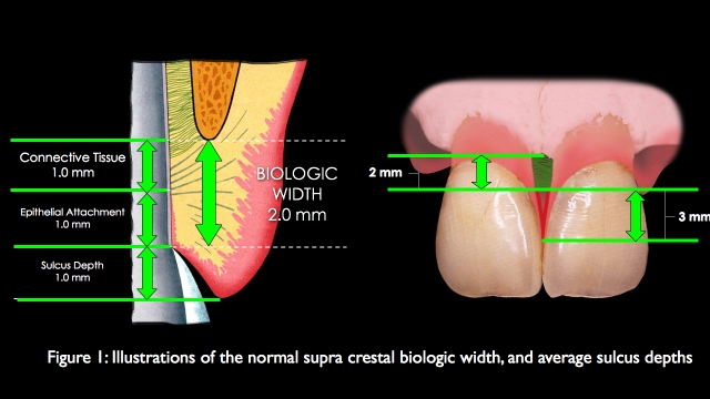 The Challenge of Replacing Missing Central and Lateral Incisors Frank Spear The Challenge of Replacing Missing Central and Lateral Incisors Figure 1