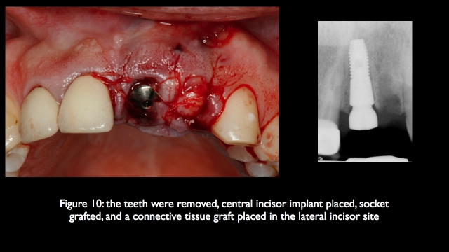 The Challenge of Replacing Missing Central and Lateral Incisors Frank Spear The Challenge of Replacing Missing Central and Lateral Incisors Figure 10