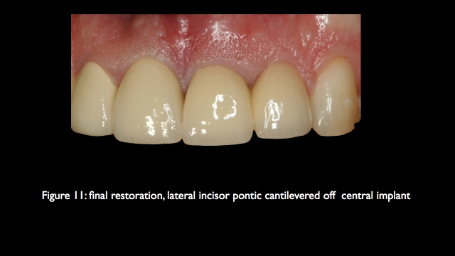The Challenge of Replacing Missing Central and Lateral Incisors Frank Spear The Challenge of Replacing Missing Central and Lateral Incisors Figure 11