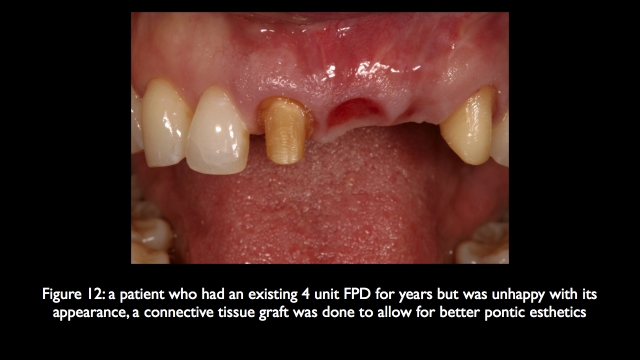 The Challenge of Replacing Missing Central and Lateral Incisors Frank Spear The Challenge of Replacing Missing Central and Lateral Incisors Figure 12