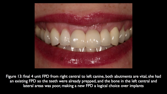 The Challenge of Replacing Missing Central and Lateral Incisors Frank Spear The Challenge of Replacing Missing Central and Lateral Incisors Figure 13