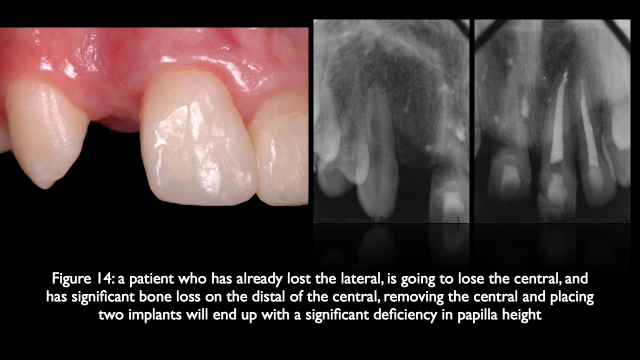 The Challenge of Replacing Missing Central and Lateral Incisors Frank Spear The Challenge of Replacing Missing Central and Lateral Incisors Figure 14