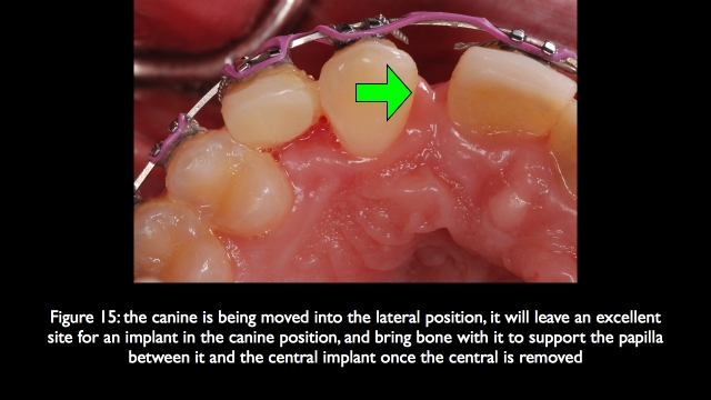 The Challenge of Replacing Missing Central and Lateral Incisors Frank Spear The Challenge of Replacing Missing Central and Lateral Incisors Figure 15