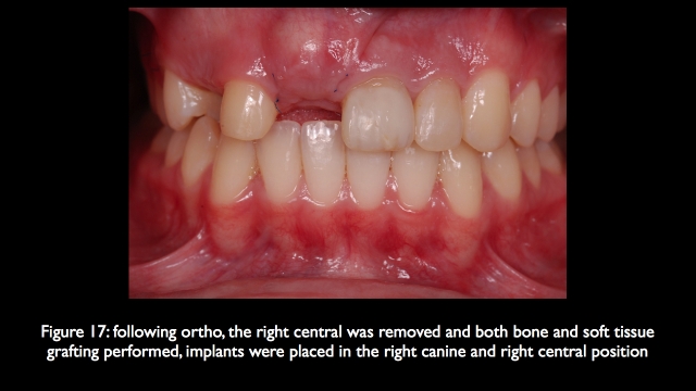 The Challenge of Replacing Missing Central and Lateral Incisors Frank Spear The Challenge of Replacing Missing Central and Lateral Incisors Figure 17