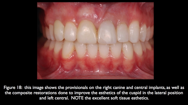 The Challenge of Replacing Missing Central and Lateral Incisors Frank Spear The Challenge of Replacing Missing Central and Lateral Incisors Figure 18