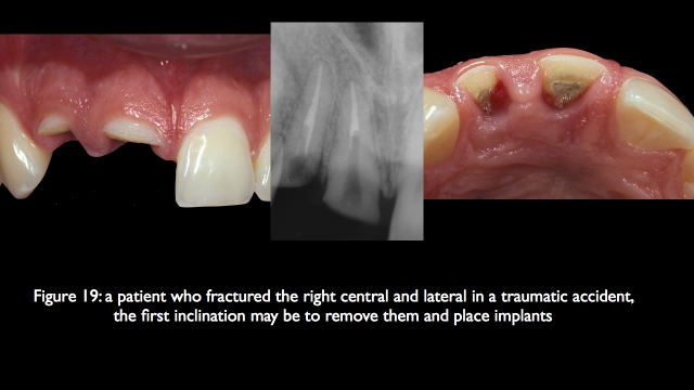 The Challenge of Replacing Missing Central and Lateral Incisors Frank Spear The Challenge of Replacing Missing Central and Lateral Incisors Figure 19