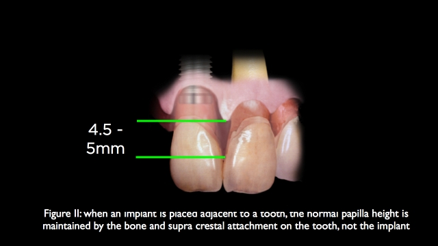 The Challenge of Replacing Missing Central and Lateral Incisors Frank Spear The Challenge of Replacing Missing Central and Lateral Incisors Figure 2