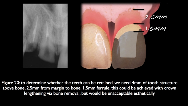 The Challenge of Replacing Missing Central and Lateral Incisors Frank Spear The Challenge of Replacing Missing Central and Lateral Incisors Figure 20