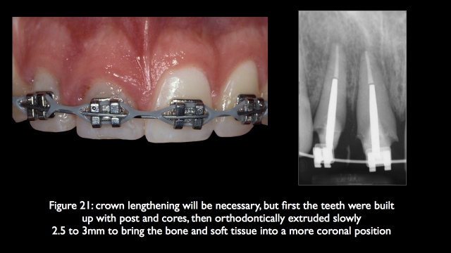 The Challenge of Replacing Missing Central and Lateral Incisors Frank Spear The Challenge of Replacing Missing Central and Lateral Incisors Figure 21