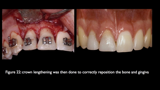 The Challenge of Replacing Missing Central and Lateral Incisors Frank Spear The Challenge of Replacing Missing Central and Lateral Incisors Figure 22